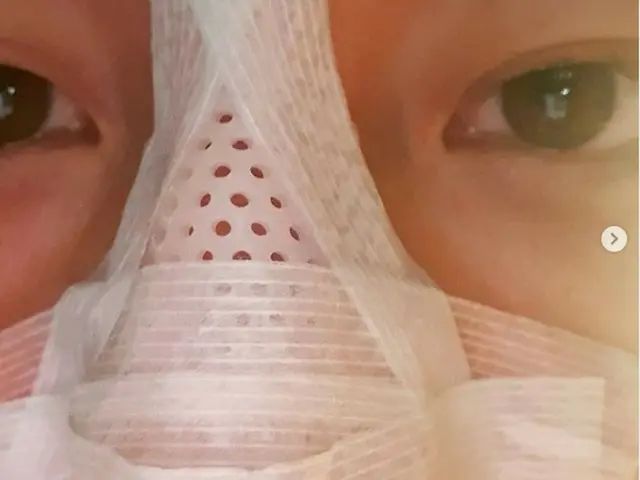 배우 한정수, 농구 중 코뼈를 부러 뜨린 것을 SNS에서 밝힌다. .