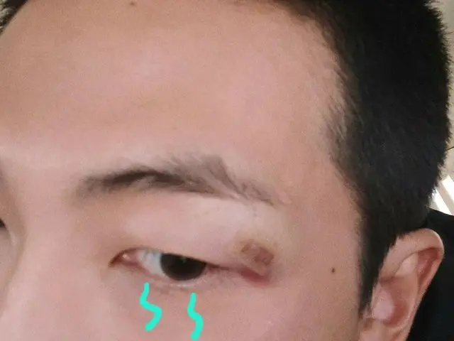 RM, 눈썹 아래 생긴 상처를 공개해 팬들이 걱정.
