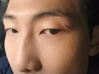 'BTS' RM, 잘생긴 얼굴에 깊은 상처가… 아픈 눈 위의 상처 공개